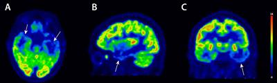 Case Report: Semantic Variant of Primary Progressive Aphasia Associated With Anti-Glial Fibrillary Acid Protein Autoantibodies